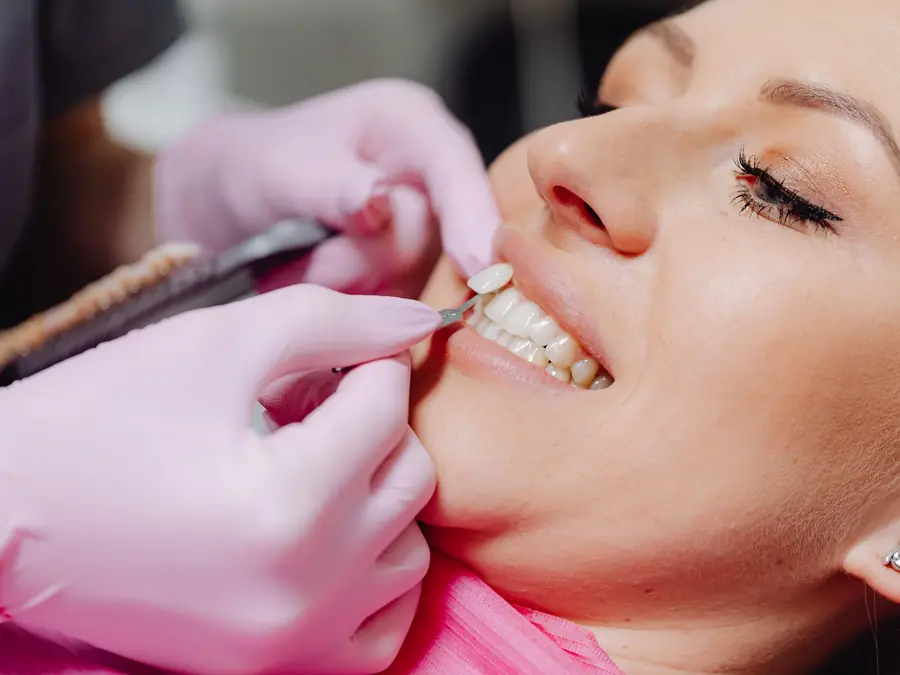 Medic stomatolog aplicând o fațetă dentară unei paciente